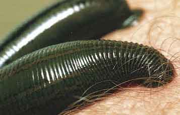 Leech therapy